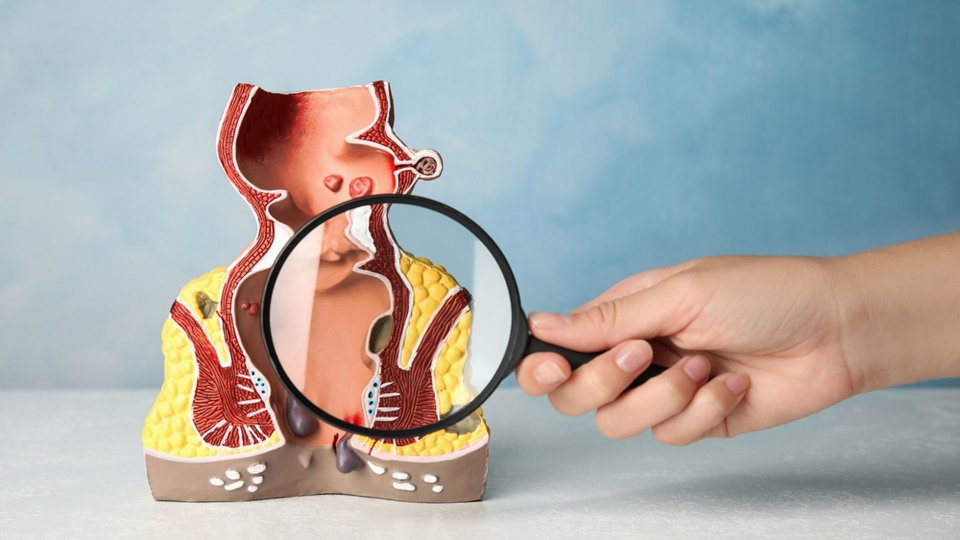 Perianal Fistül Nedir? Perianal Fistüs Ameliyatı Nasıl Yapılır?