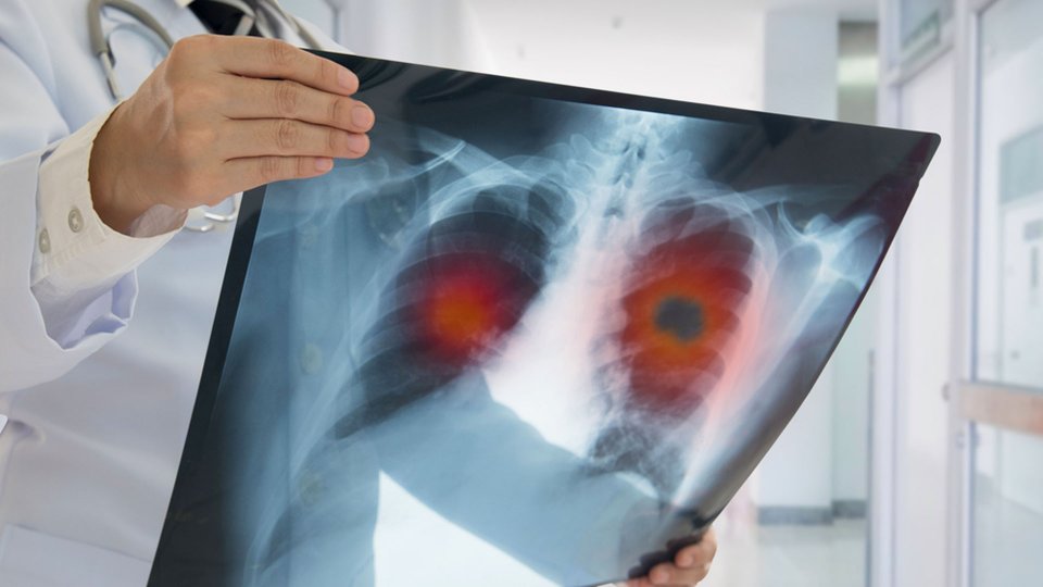 Pulmoner Emboli (Akciğer Pıhtısı) Nedir? Pulmoner Emboli Öldürür mü?