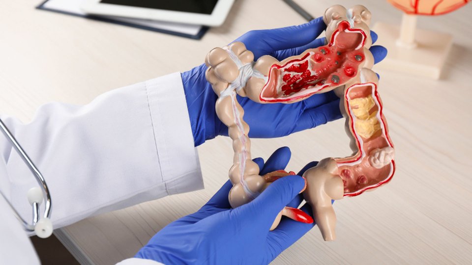 Rektum Kanseri Nedir? Rektum Kanseri Belirtileri