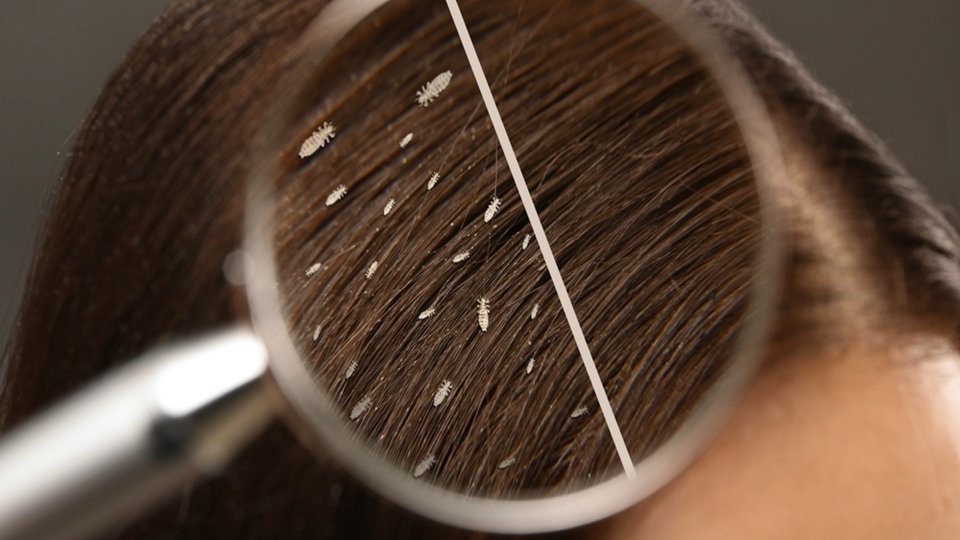 Saç Biti Neden Olur? Nasıl Temizlenir?