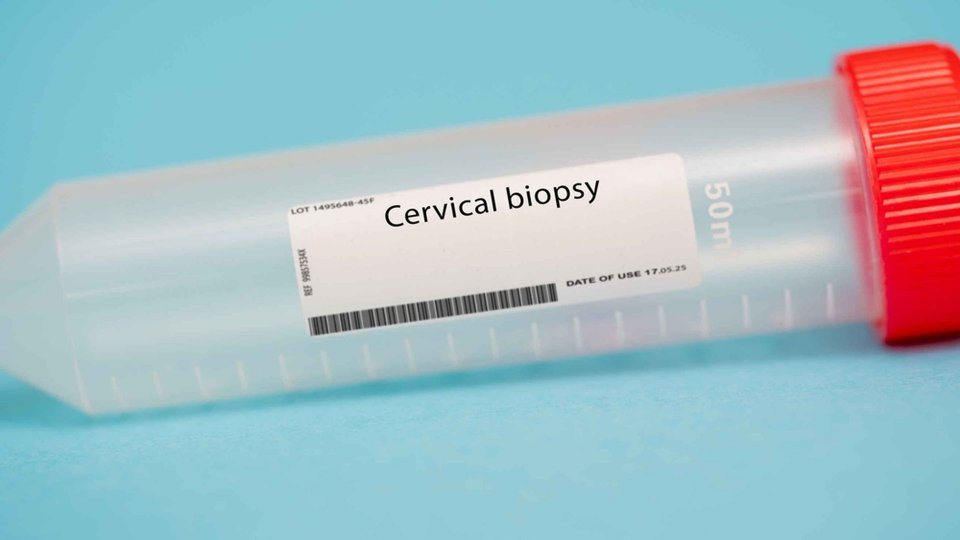 Servikal Biyopsi ve Tanısal Küretaj