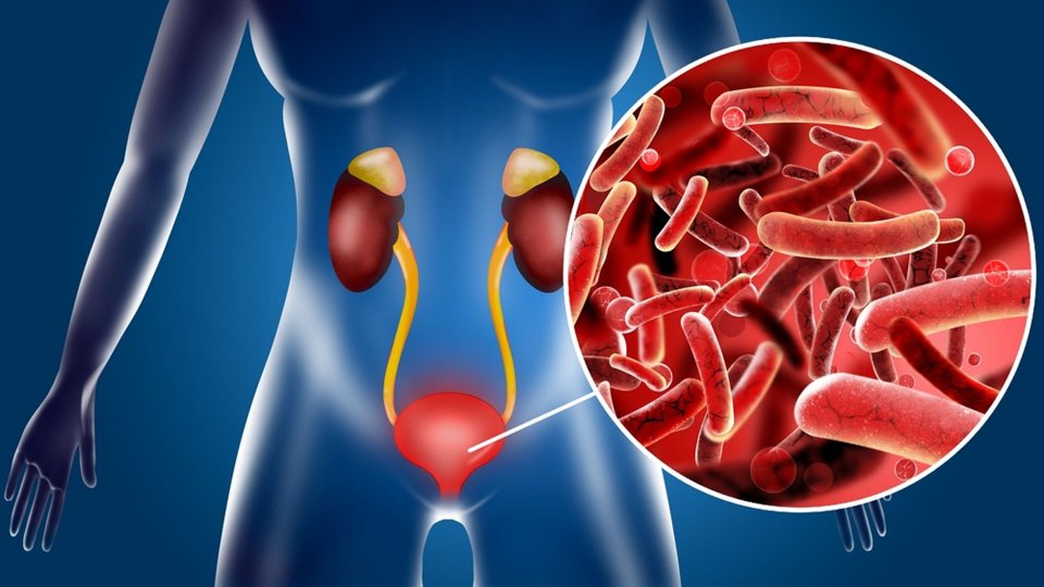 Sistit Nedir? Sistit Belirtileri Nelerdir?