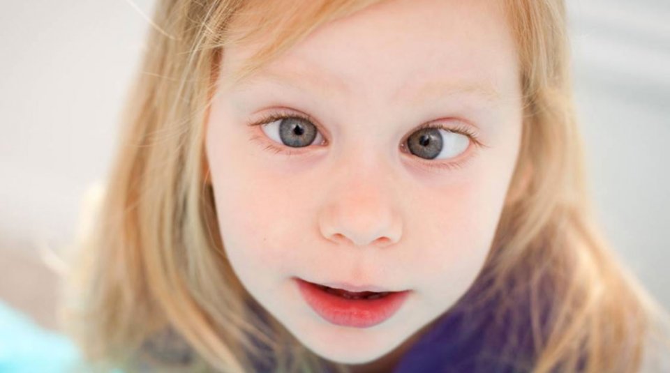 Şaşılıkta Erken Teşhis Önemli