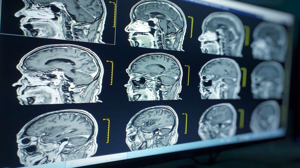 Subdural Hematom Nedir? Belirtileri Nelerdir?