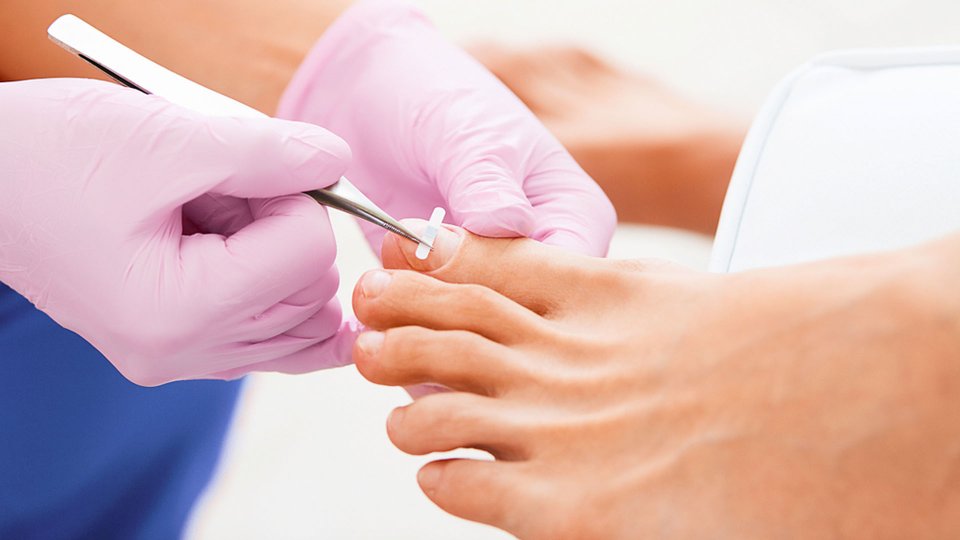 Tırnak Batması Nedir? Belirtileri ve Tedavi Yöntemleri Nelerdir?