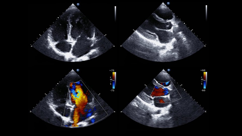 Trans Özofageal Ekokardiyografi (TEE) Nedir? Hangi Hastalıklar İçin Uygulanır?