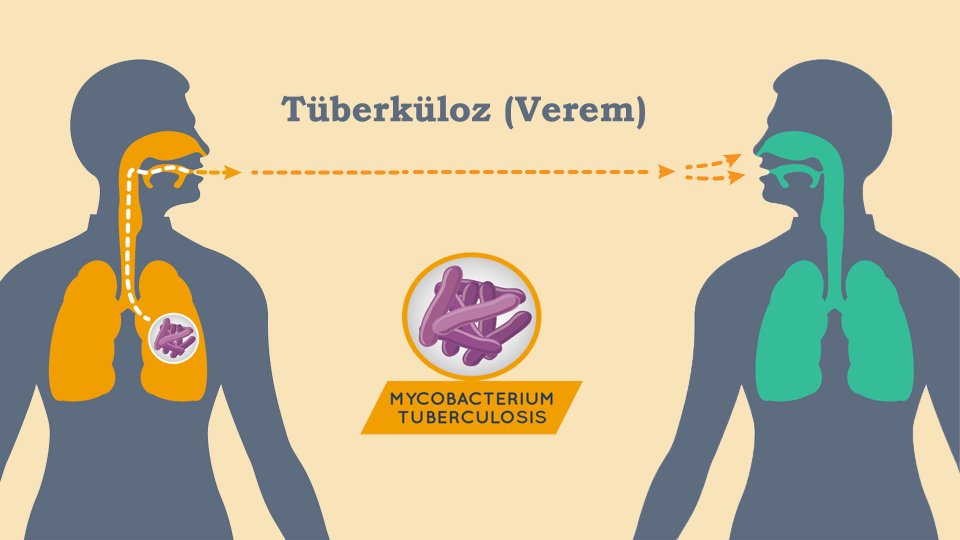 İnsanlık Tarihinin En Ölümcül Hastalığı: Tüberküloz 