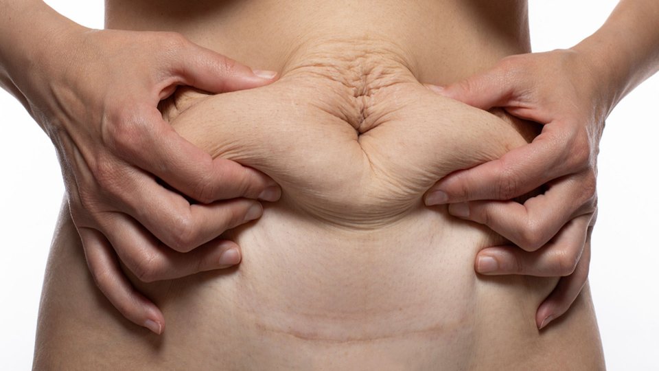 Tüp mide ameliyatı ile 49 kilo verdi