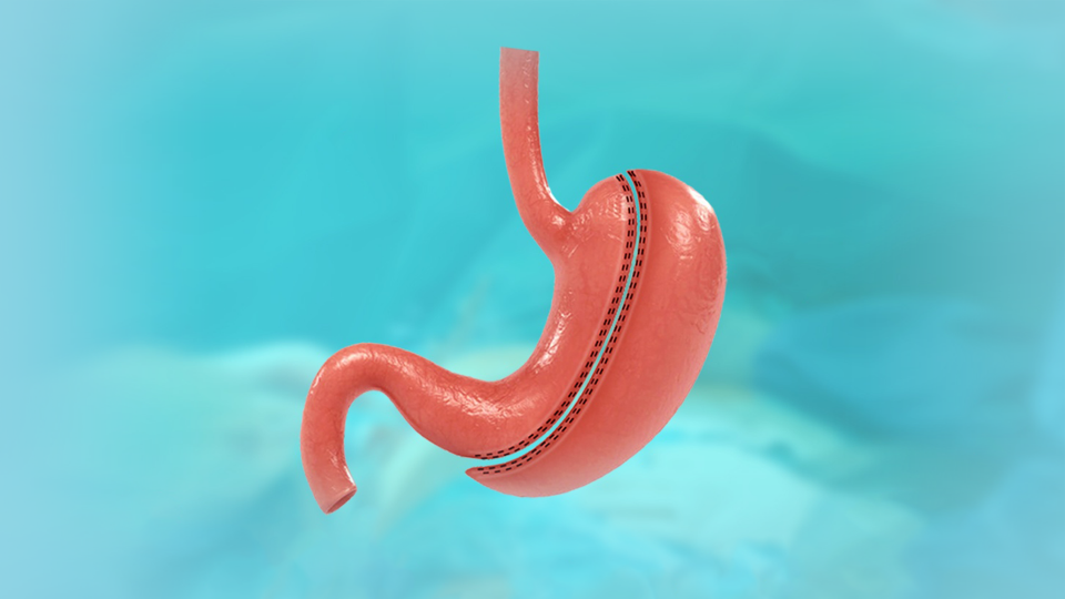 Tüp Mide (Sleeve Gastrektomi)