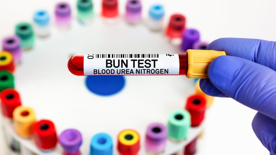 Üre (Bun) Testi Nedir? 