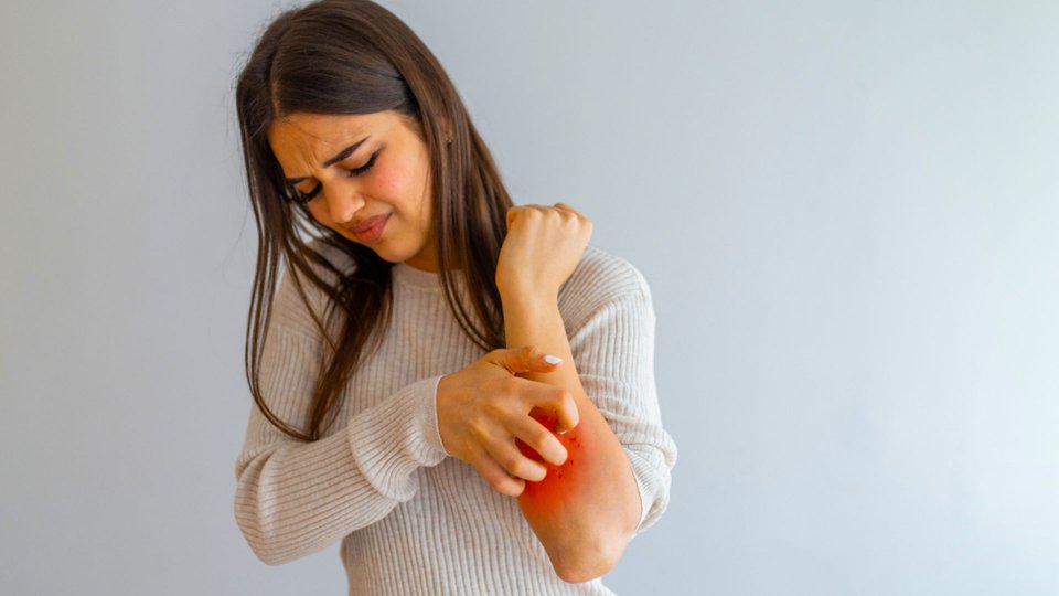 Bulaşıcılığı Yüksek Bir Cilt Hastalığı: Uyuz Hastalığı Nedir?