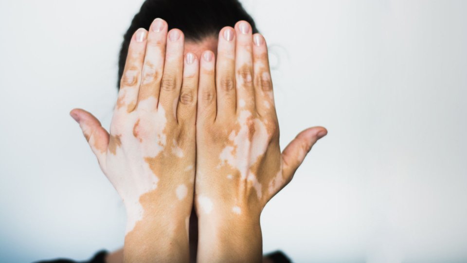 Vitiligo Nedir? Vitiligo Belirtileri ve Tedavisi