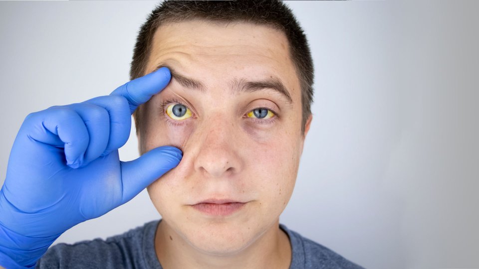 Weil Hastalığı Nedir? Weil Hastalığı Nasıl Bulaşır?