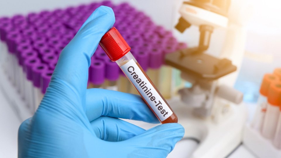 İdrarda Kreatinin Yüksekliği Nedir? Kreatinin Nasıl Düşürülür?