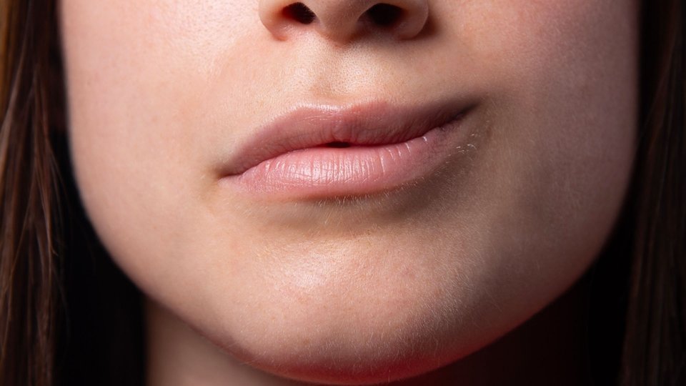 Yüz Felci Nedir? Yüz Felci Belirtileri ve Tedavisi