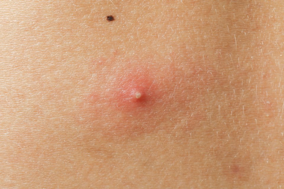 Genital Bölgede Sivilce Neden Çıkar? Genital Bölgede Sivilce Nasıl Geçer?