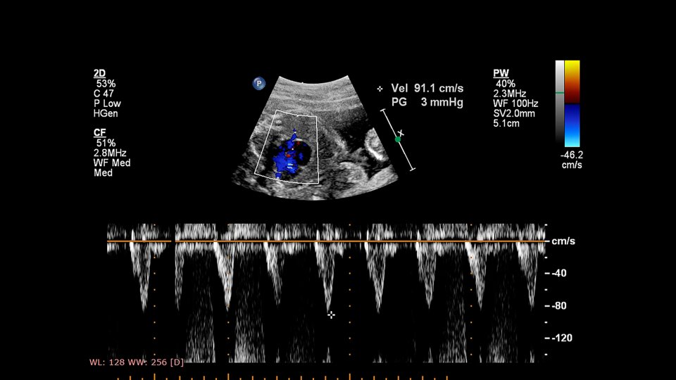 Fetal Ekokardiyografi Nasıl Uygulanır?