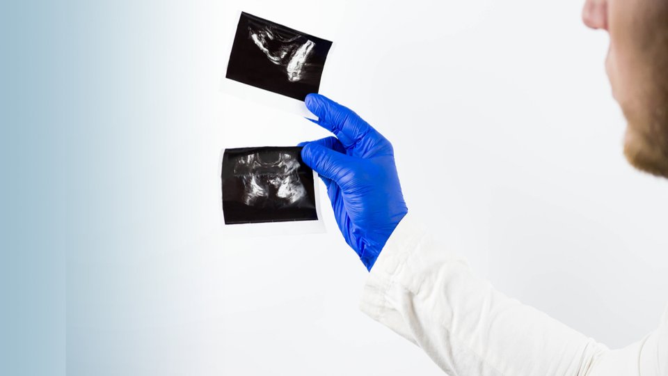 Füzyon Prostat Biyopsi Nedir? Nasıl Uygulanır?