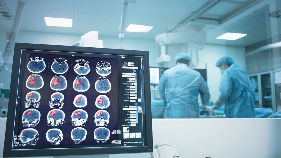 Glial Tümör Ameliyatı Nedir? Nasıl Yapılır?