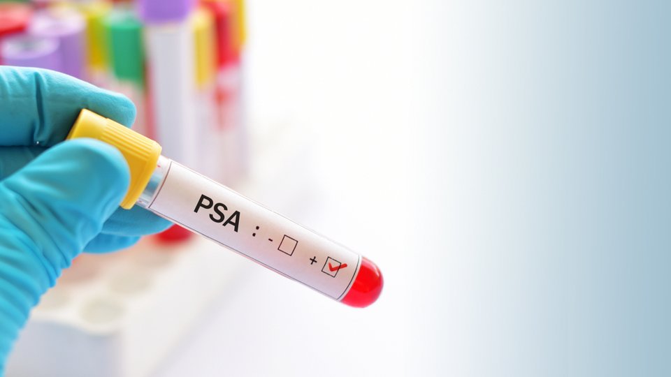 PSA Testi Nedir? 