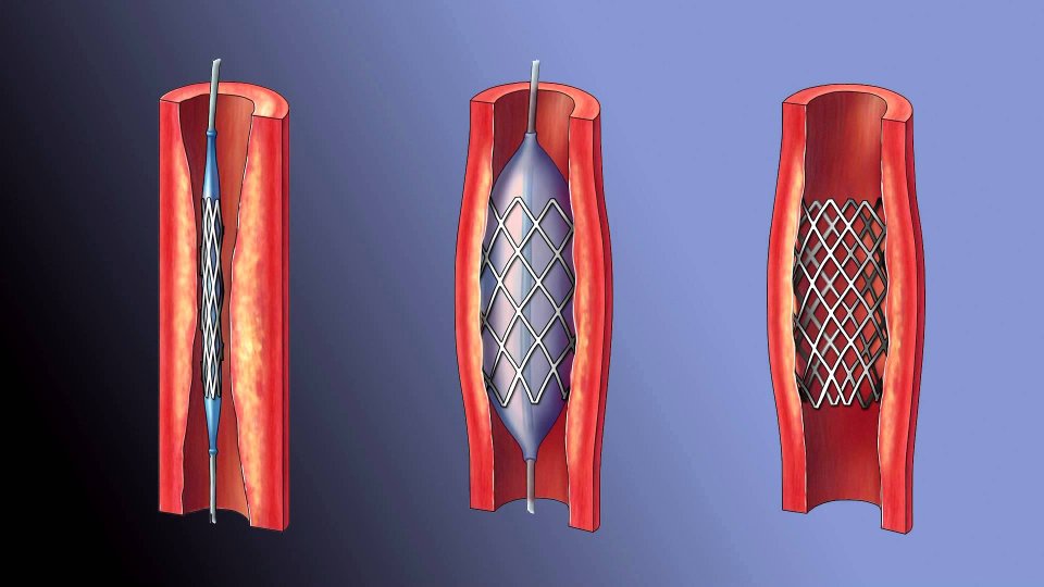 İdrar Yollarındaki Darlığa Stent'li Çözüm