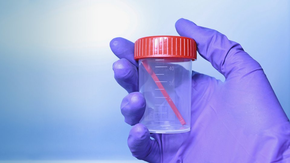 Dışkıda Gizli Kan Testi Nedir? Neden Yapılır?  