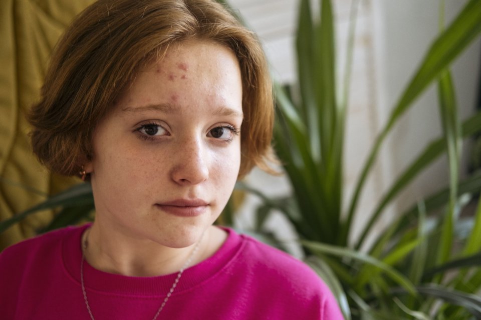 Ergenlikte Sivilceler Neden Israrcıdır? Cildin Verdiği Gizli Mesajlar