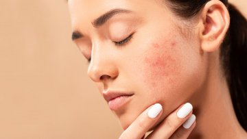Akne (Sivilce) Nedir? Neden Oluşur?