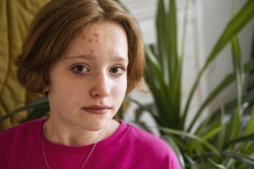 Ergenlikte Sivilceler Neden Israrcıdır? Cildin Verdiği Gizli Mesajlar