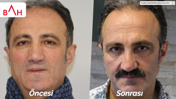 4. burun ameliyatından sonra gelen mutluluk